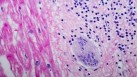 Sarcoidosis is a chronic inflammatory disease characterised by the formation of tiny lumps known as granulomas in the lungs and other organs.(Unsplash)