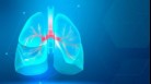 Popcorn lung, or bronchiolitis obliterans, is a rare lung disease that harms the small air sacs and passages in the lungs, known as bronchioles(Freepik)