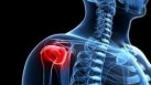 Frozen shoulder: Management and treatment options