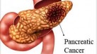 How to identify and manage the early signs of pancreatic cancer? (Photo by Yahoo)