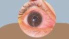 Iritis or inflammation of the iris: Causes, symptoms and care tips for your eyes (Photo by Twitter/homeopathy360)