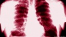 New insight into tuberculosis treatment: Research(GARO/PHANIE/picture alliance)