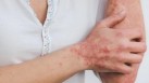 Psoriasis management: Guidelines for safe sun exposure in psoriasis treatment (File Photo)