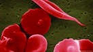 A genetic mutation causes cells to become sickle or crescent-shaped, which can block blood flow. (DW/NCATS/AP/picture alliance)