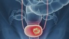 Why one type of chemotherapy works best in bladder cancer: Study reveals(Twitter/MedscapeCME)