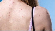 How-to-Treat-Back-Acne-722x406