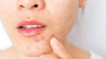 10 Surprising Causes of Adult Acne (and How to Get Rid of It)