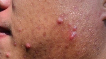 What Are the Symptoms of Different Types of Acne?