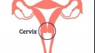 Irregular periods are not just menopause but can be sign of cervical cancer. Symptoms to watch out for (Photo by Twitter/RISCC_H2020)