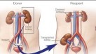 Miracles of kidney transplant: Benefits, procedure, everything to know for those suffering from end-stage renal disease (Photo by Mayo Clinic)