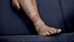 A psoriasis rash on a leg